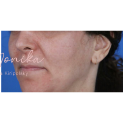 Melasma Before & After Patient #1535