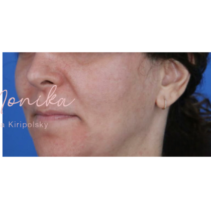Melasma Before & After Patient #1535