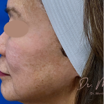 Hyperpigmentation Before & After Patient #1633