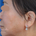 Hyperpigmentation Before & After Patient #1633