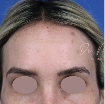 Hyperpigmentation Before & After Patient #1664