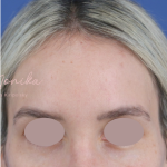 Hyperpigmentation Before & After Patient #1664