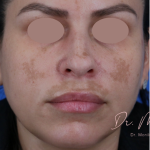 Hyperpigmentation Before & After Patient #1666