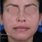 Hyperpigmentation Before & After Patient #1666