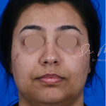 Hyperpigmentation Before & After Patient #1667