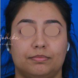 Hyperpigmentation Before & After Patient #1667