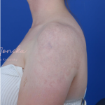 Tattoo Removal Before & After Patient #1672