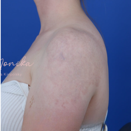 Tattoo Removal Before & After Patient #1672