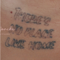Tattoo Removal Before & After Patient #1674