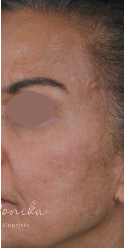 Chemical Peel Before & After Patient #1665