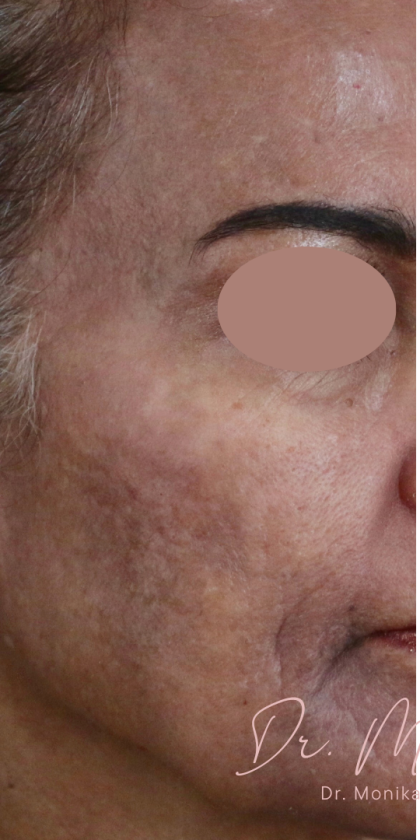 Chemical Peel Before & After Patient #1665