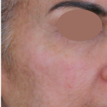 Chemical Peel Before & After Patient #1665