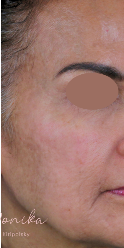 Chemical Peel Before & After Patient #1665