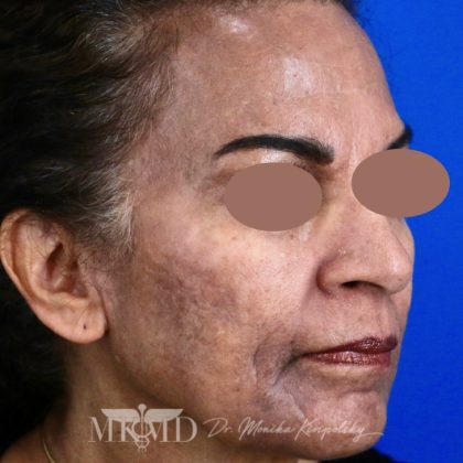Hyperpigmentation Before & After Patient #1665