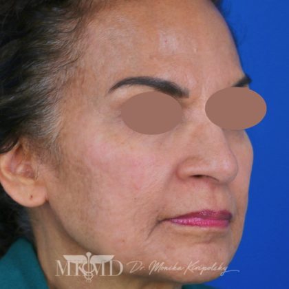 Hyperpigmentation Before & After Patient #1665