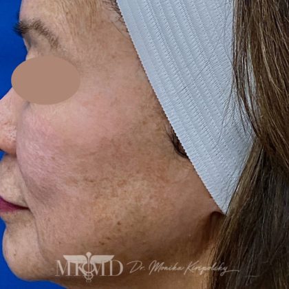Hyperpigmentation Before & After Patient #1633