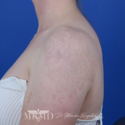 Tattoo Removal Before & After Patient #1672