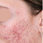 Acne Scarring Before & After Patient #1680