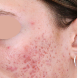 Acne Scarring Before & After Patient #1680