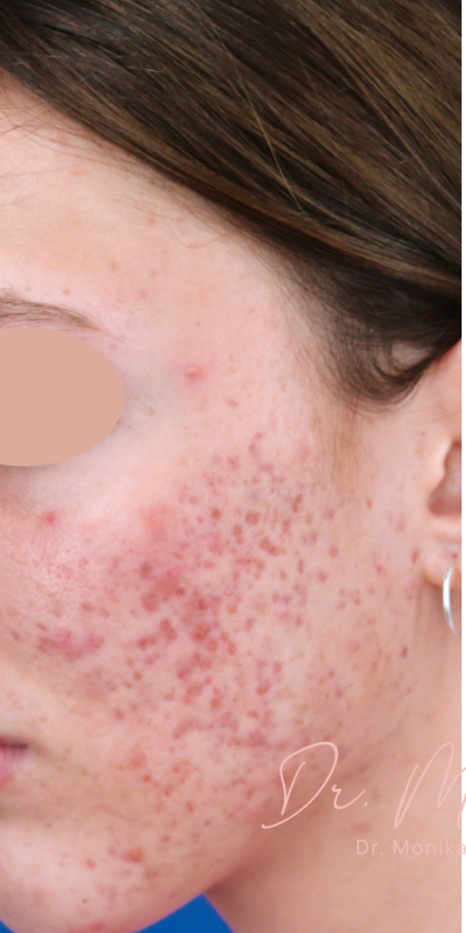 Acne Scarring Before & After Patient #1680