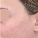 Acne Scarring Before & After Patient #1680