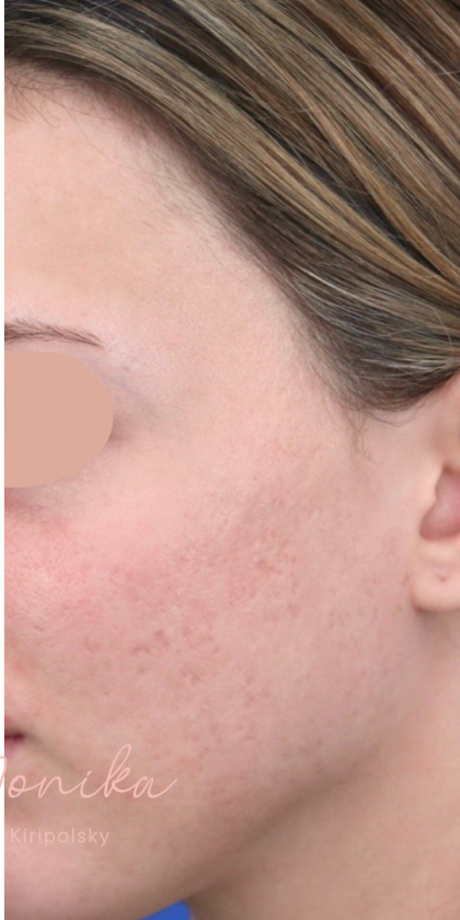 Acne Scarring Before & After Patient #1680