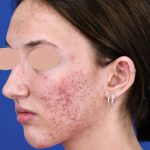 Acne Scarring Before & After Patient #1680