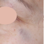 Hyperpigmentation Before & After Patient #1727