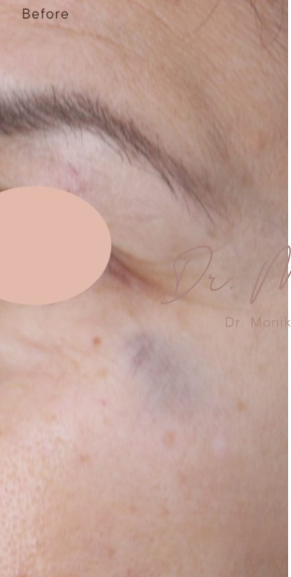 Hyperpigmentation Before & After Patient #1727