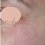 Hyperpigmentation Before & After Patient #1727