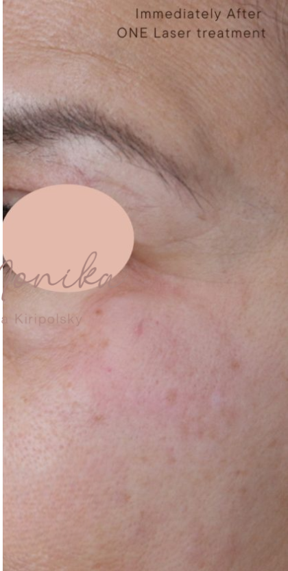 Hyperpigmentation Before & After Patient #1727