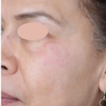 Hyperpigmentation Before & After Patient #1727