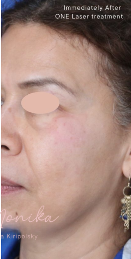 Hyperpigmentation Before & After Patient #1727