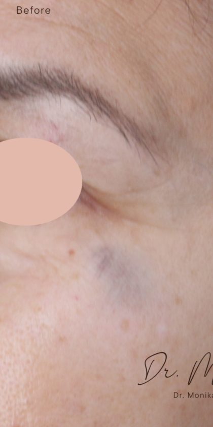 Hyperpigmentation Before & After Patient #1727