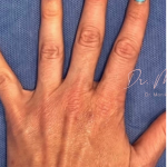 Hand Filler Before & After Patient #1762