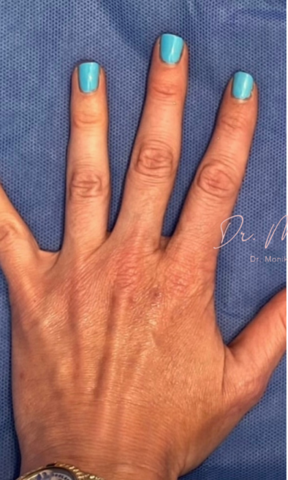 Hand Filler Before & After Patient #1762