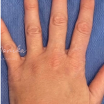 Hand Filler Before & After Patient #1762