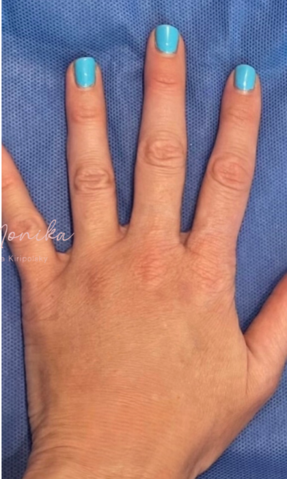 Hand Filler Before & After Patient #1762