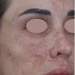 Hyperpigmentation Before & After Patient #1843