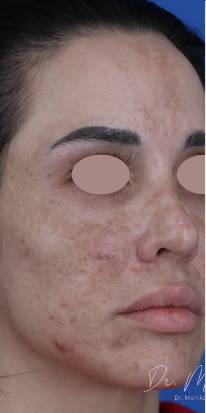 Hyperpigmentation Before & After Patient #1843