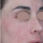 Hyperpigmentation Before & After Patient #1843