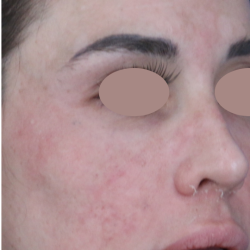 Chemical Peel Before & After Patient #1843