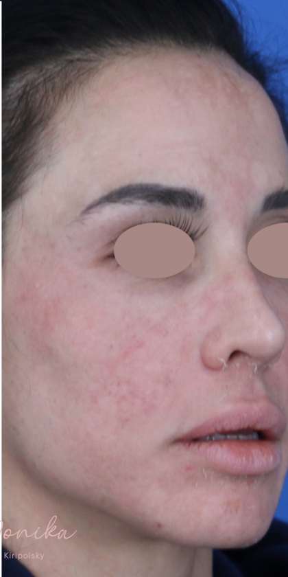 Hyperpigmentation Before & After Patient #1843