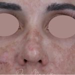 Hyperpigmentation Before & After Patient #1843