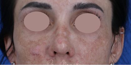 Hyperpigmentation Before & After Patient #1843