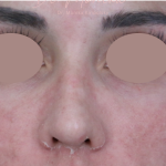 Hyperpigmentation Before & After Patient #1843