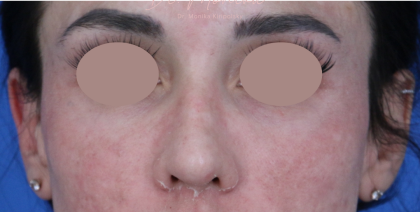 Hyperpigmentation Before & After Patient #1843