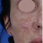 Chemical Peel Before & After Patient #1843