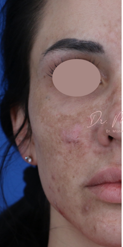 Hyperpigmentation Before & After Patient #1843