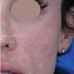 Hyperpigmentation Before & After Patient #1843